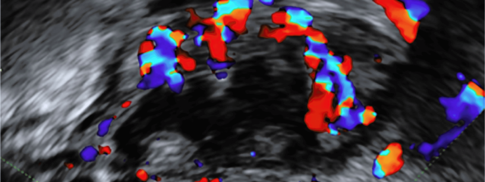 Learning from the masters: detecting adenomyosis and endometriosis