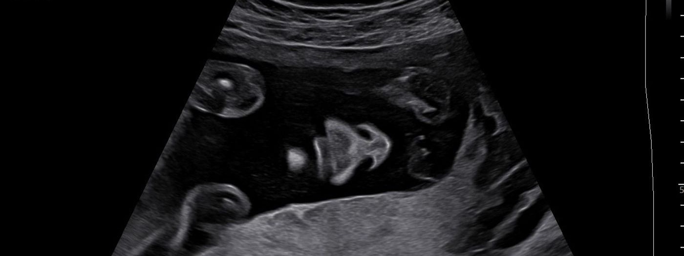 Using Ultrasound and AI in Obstetrics