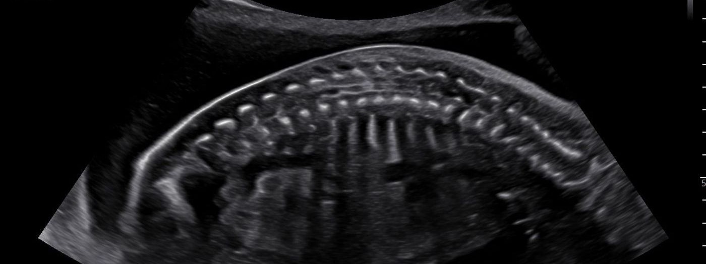 How to get the best ultrasound image in obstetrical scans